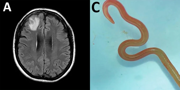 Brain worm